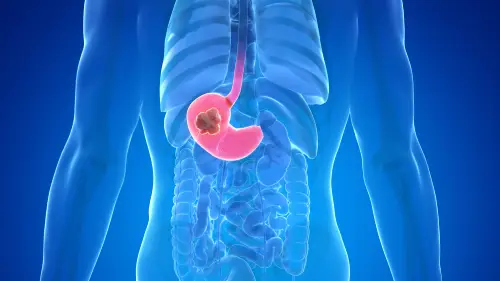 cancer de estomago gastroenterologo en lima