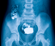 extracción de cuerpos extraños